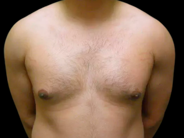 Gynecomastia Patient 05 Before 1