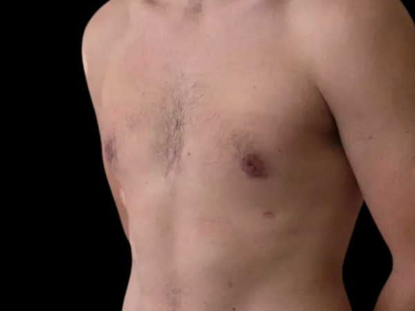 Gynecomastia #699 After 2