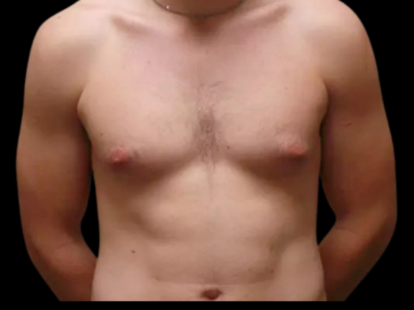 Gynecomastia #699 Before 1