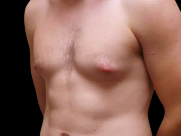 Gynecomastia #699 Before 2