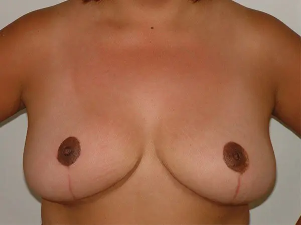 Breast Reduction Patient 08 After 1