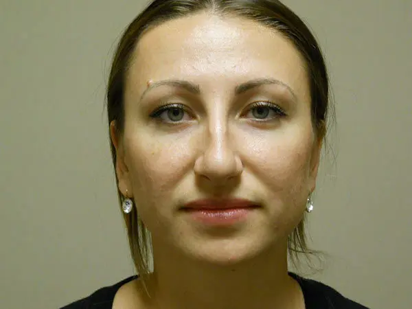 Rhinoplasty Patient 01 Before 1