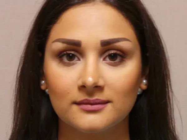 Rhinoplasty Patient 29 After 1