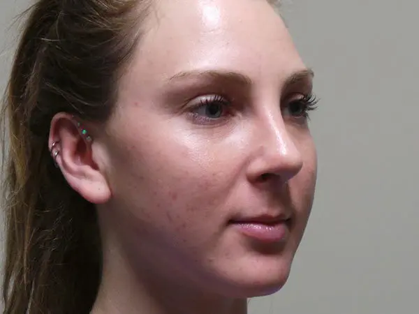 Rhinoplasty Patient 27 After 2