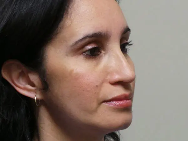 Rhinoplasty Patient 13 After 2