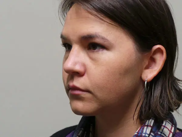 Rhinoplasty Patient 28 After 2