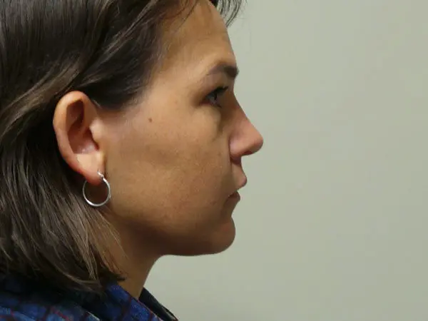 Rhinoplasty Patient 28 After 1