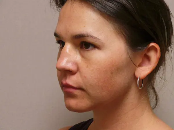 Rhinoplasty Patient 28 Before 2