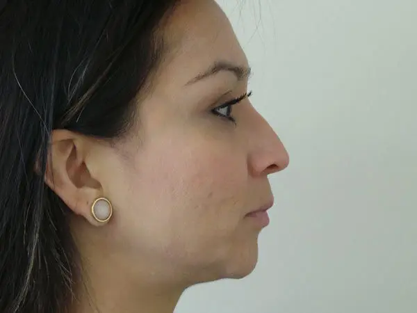 Rhinoplasty Patient 25 Before 1