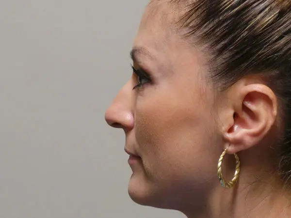 Rhinoplasty Patient 26 Before 1