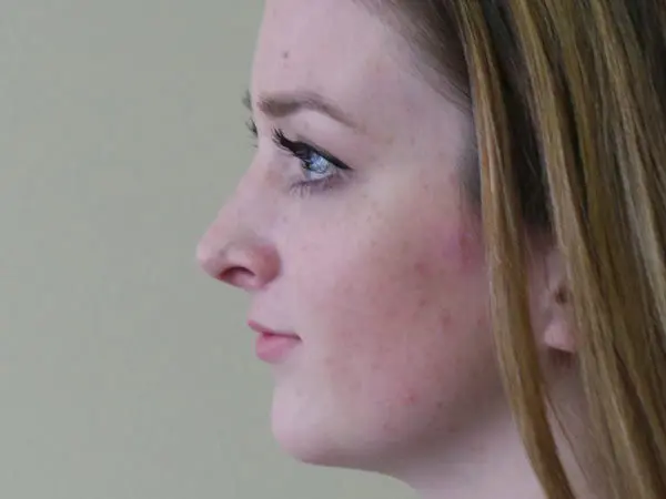 Rhinoplasty Patient 23 After 1