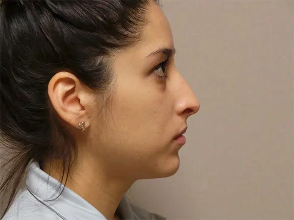 Rhinoplasty Patient 20 Before 1