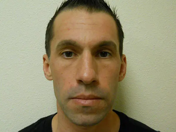 Rhinoplasty Patient 02 Before 1