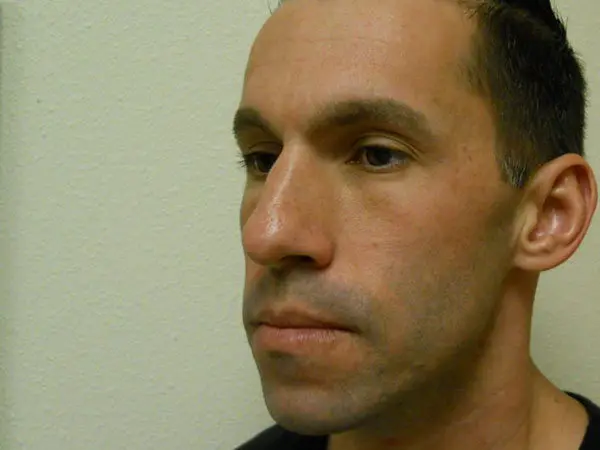 Rhinoplasty Patient 02 Before 2