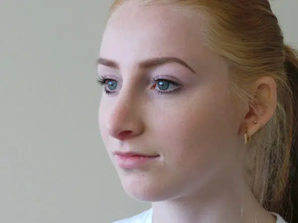 Rhinoplasty Patient 16 After 2