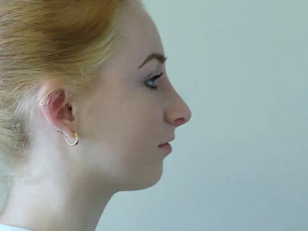 Rhinoplasty Patient 16 After 1