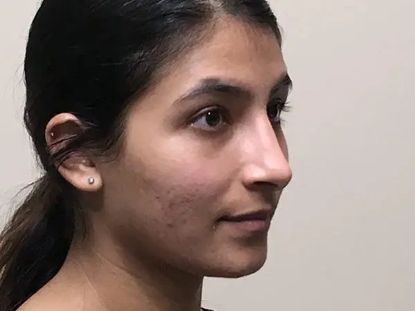 Rhinoplasty Patient 17 After 2