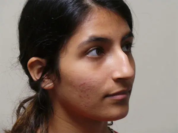 Rhinoplasty Patient 17 Before 2