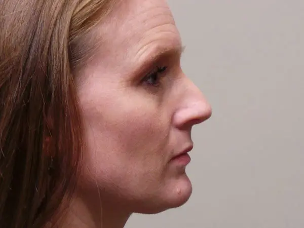 Rhinoplasty Patient 11 Before 1