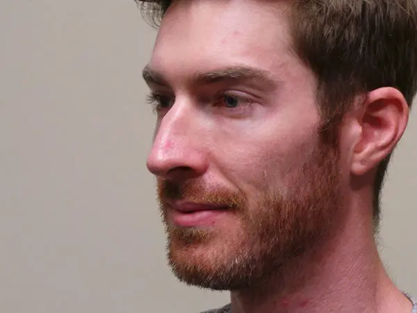 Rhinoplasty Patient 09 Before 2