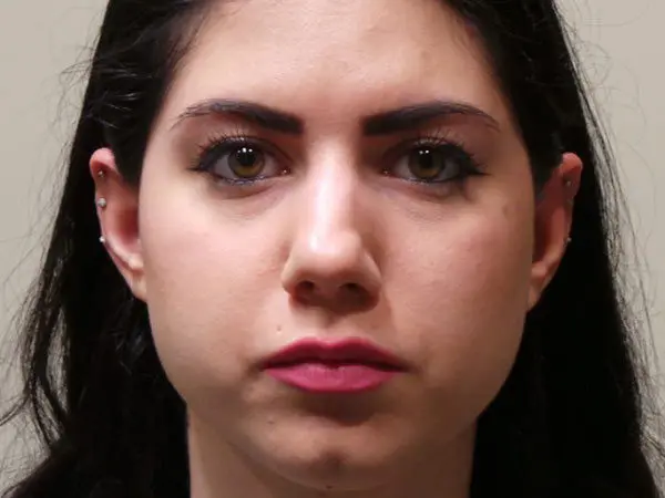 Rhinoplasty Patient 07 Before 1