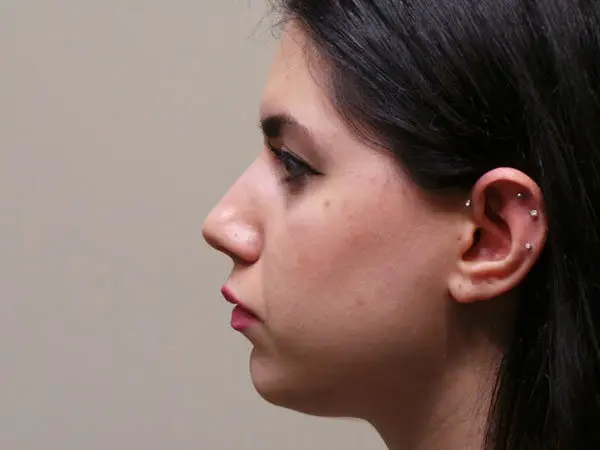 Rhinoplasty Patient 07 Before 2