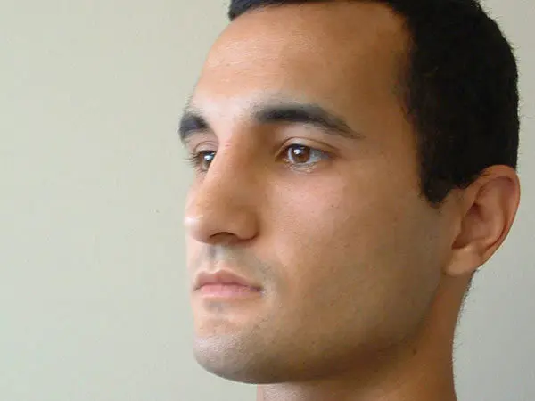 Rhinoplasty Patient 03 After 2