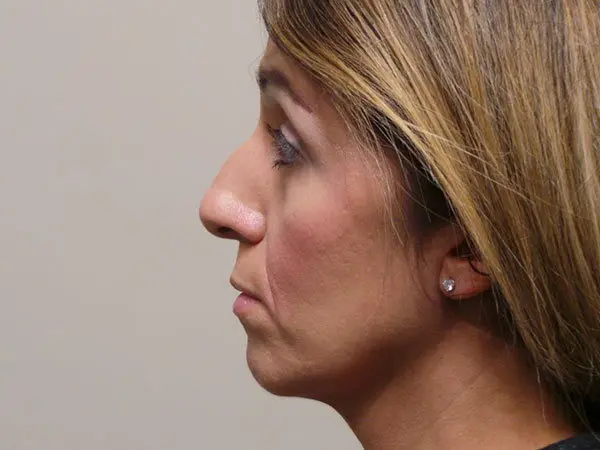 Rhinoplasty Patient 05 Before 2