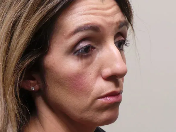 Rhinoplasty Patient 05 Before 1