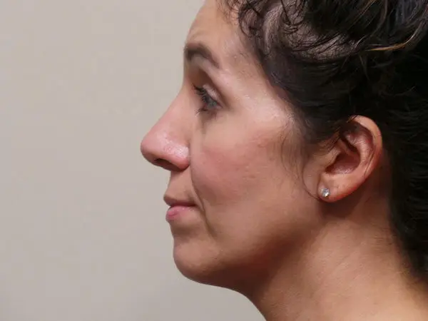 Rhinoplasty Patient 05 After 2