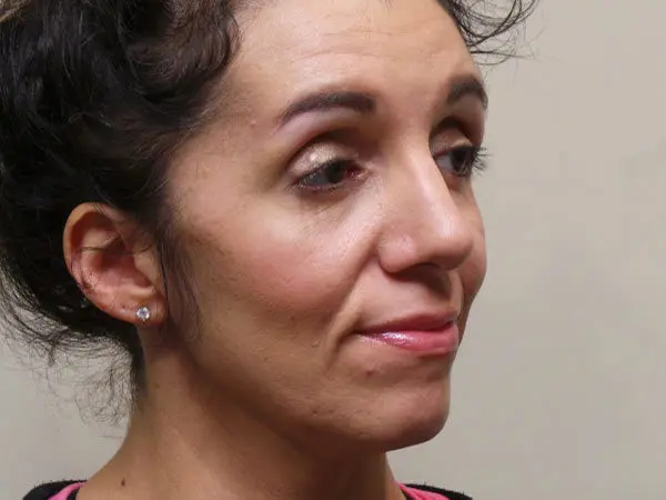 Rhinoplasty Patient 05 After 1