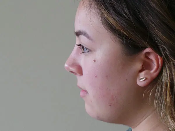 Rhinoplasty Patient 33 After 2