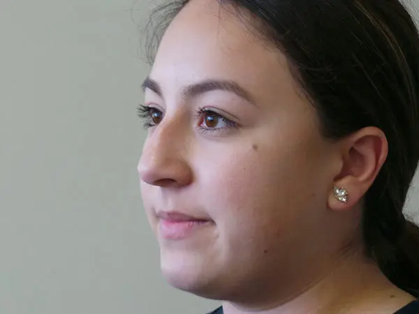 Rhinoplasty Patient 33 Before 1