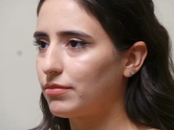 Rhinoplasty Patient 34 Before 1