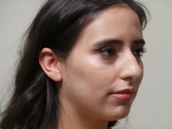 Rhinoplasty Patient 34 Before 2