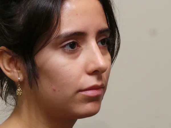 Rhinoplasty Patient 34 After 2