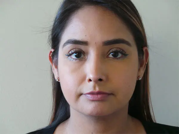 Rhinoplasty Patient 01 After 1