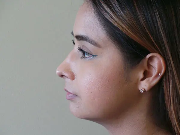 Rhinoplasty Patient 01 After 2