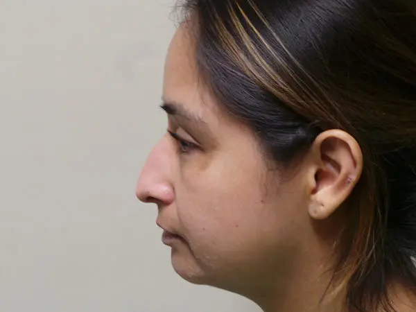 Rhinoplasty Patient 01 Before 2