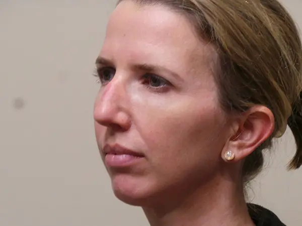 Rhinoplasty Patient 35 Before 1