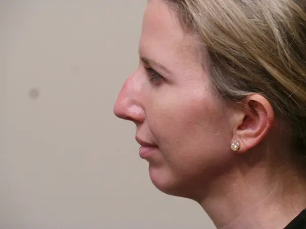 Rhinoplasty Patient 35 Before 2