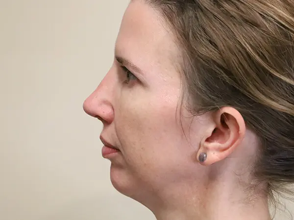 Rhinoplasty Patient 35 After 2
