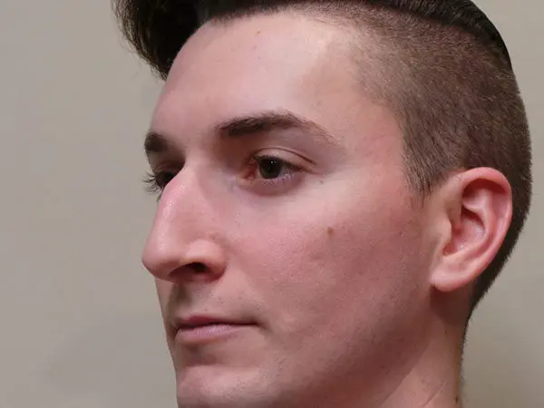 Rhinoplasty Patient 03 Before 1