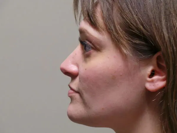 Rhinoplasty Patient 04 After 1
