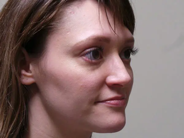 Rhinoplasty Patient 04 After 2
