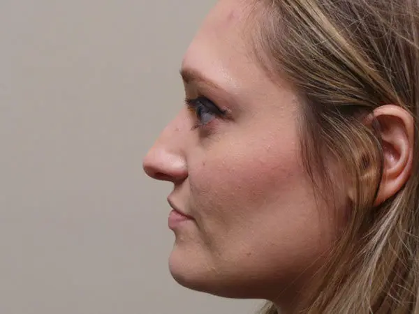Rhinoplasty Patient 04 Before 1