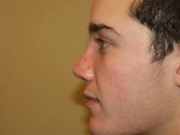 Rhinoplasty Patient 04 After 1