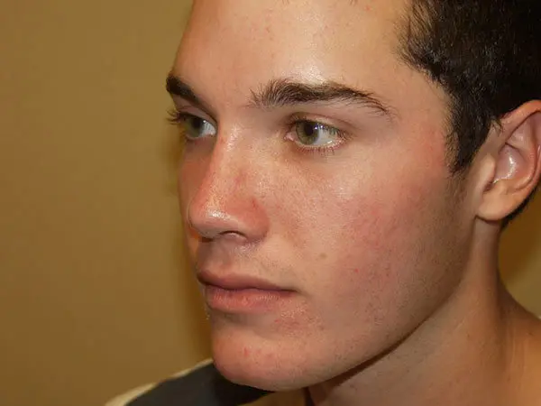 Rhinoplasty Patient 04 After 2