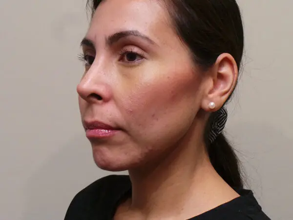 RHINOPLASTY PATIENT 02 After 1
