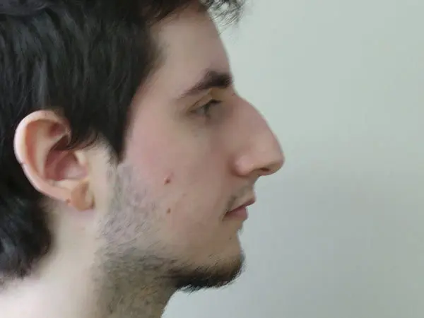 Rhinoplasty Patient 21 Before 1